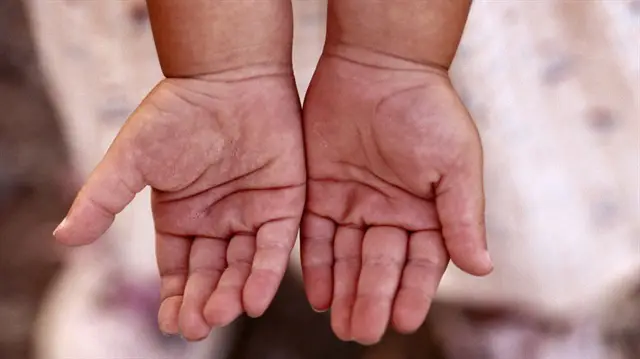 Çocuk Ellerinde Deri Soyulması Nedenleri Ve Tedavisi